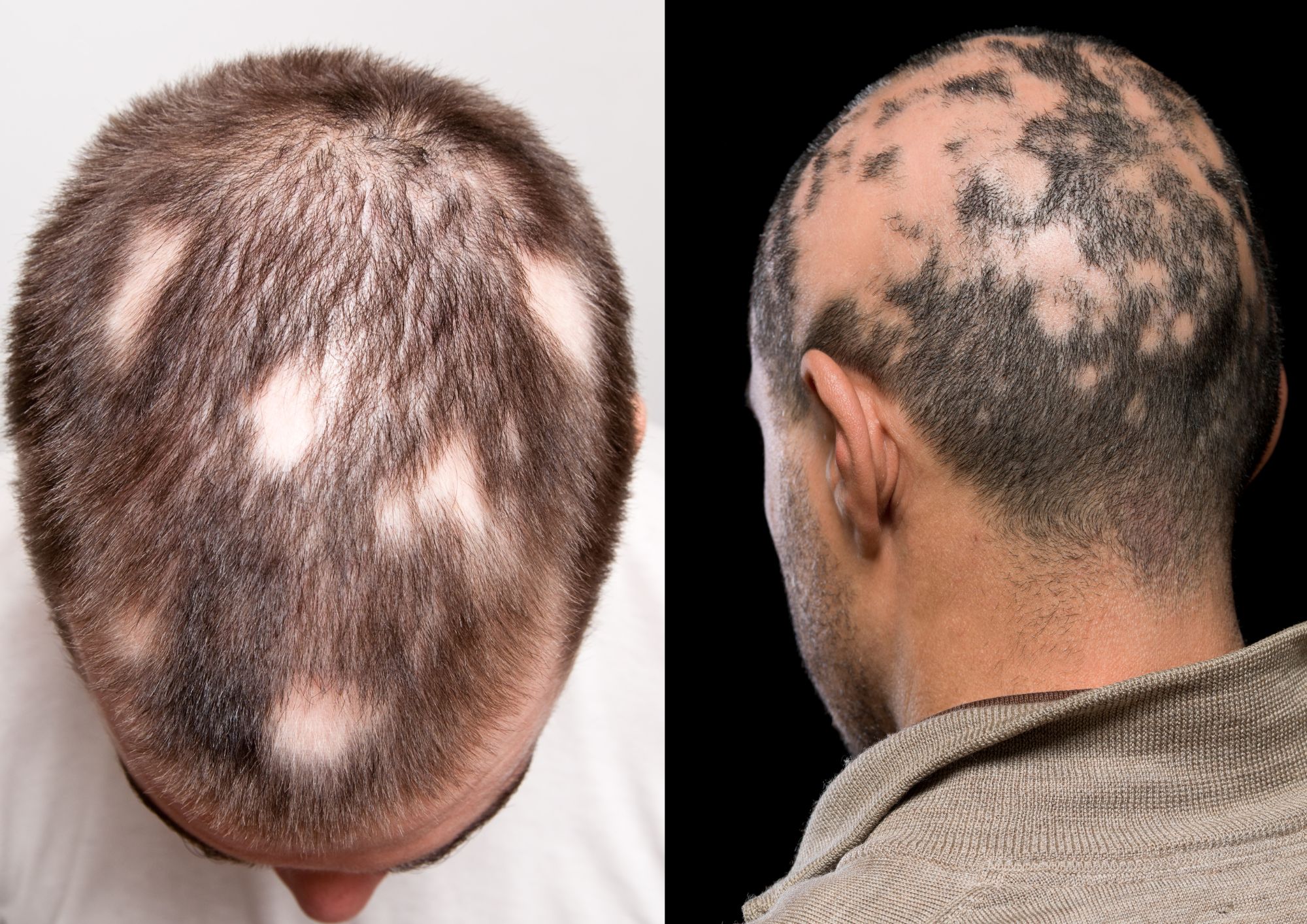 Types of Non-Genetic Hair Loss